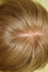 PRP Hair 2 - After Treatment